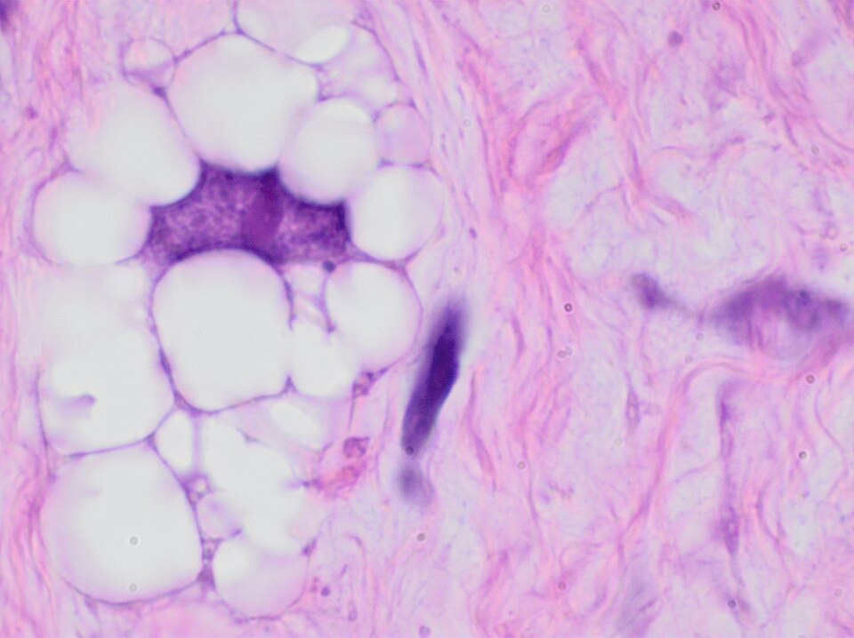 Lipoblast